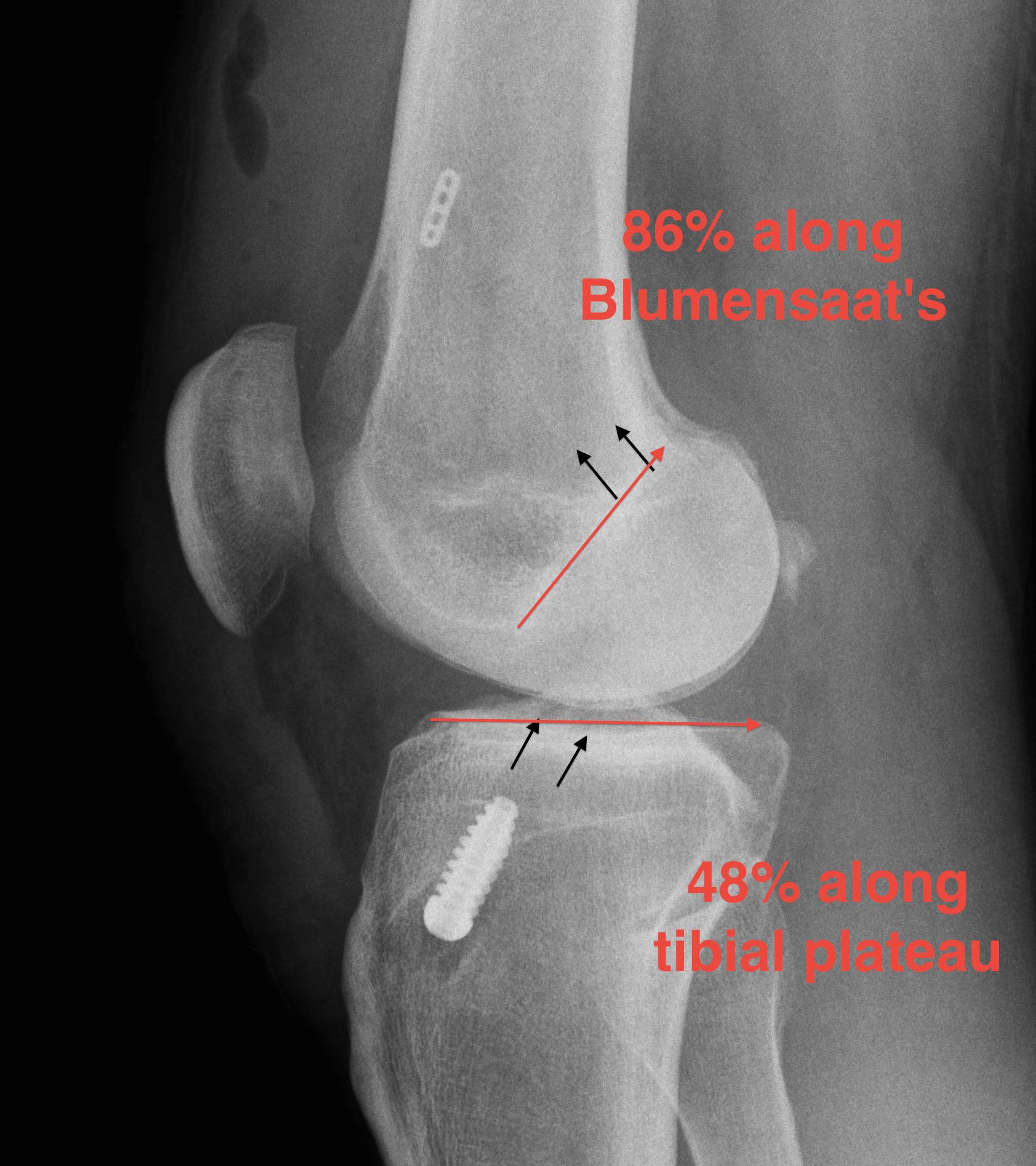 ACL Reconstruction Sagittal Tunnel Measurement